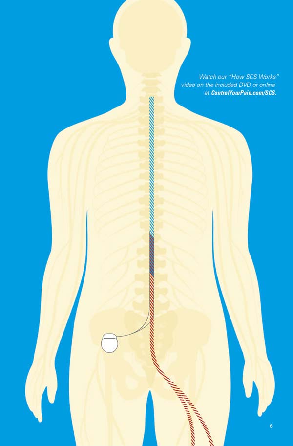 About SCS Spinal Cord Stimulation Surgery